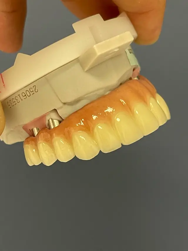 A gloved hand holding a 3D-printed model of a jaw with a dental restoration